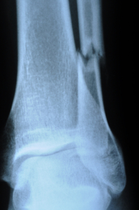 A csontritkulás miatti csonttörés gyakori a laktózérzékenyeknél.